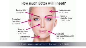 Where Not to Inject Botox?