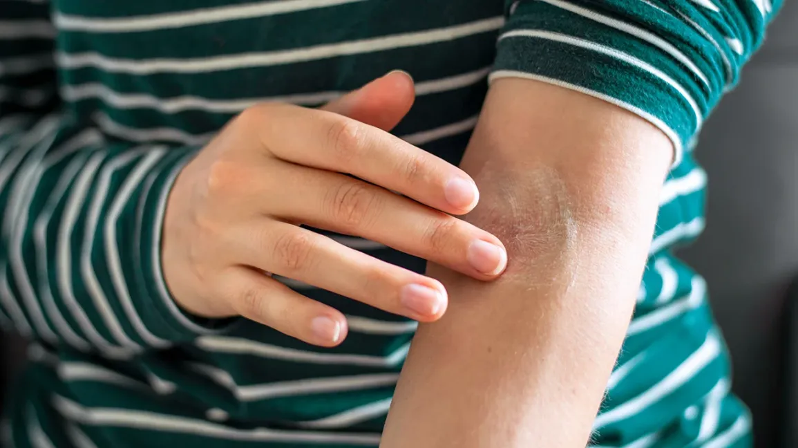 Eczema Relief