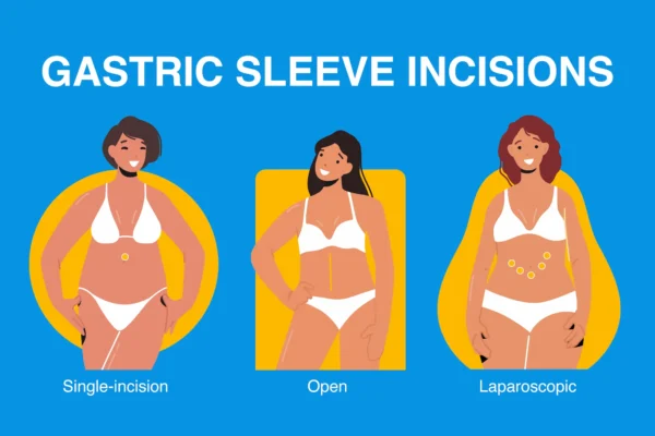 Gastric Sleeve Surgery