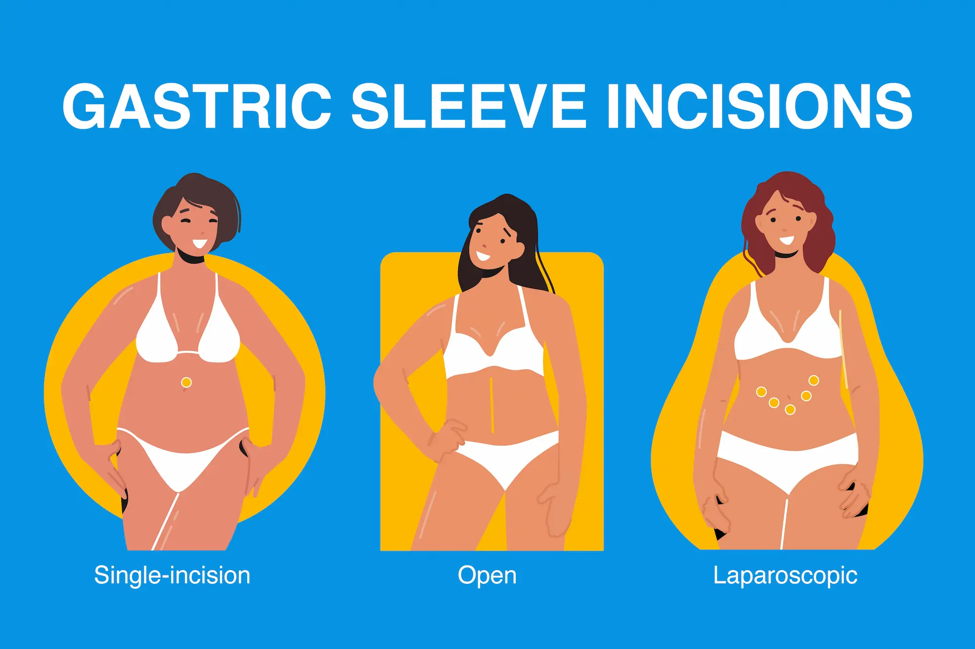 Gastric Sleeve Surgery