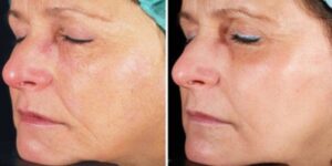Laser Wrinkle Treatment