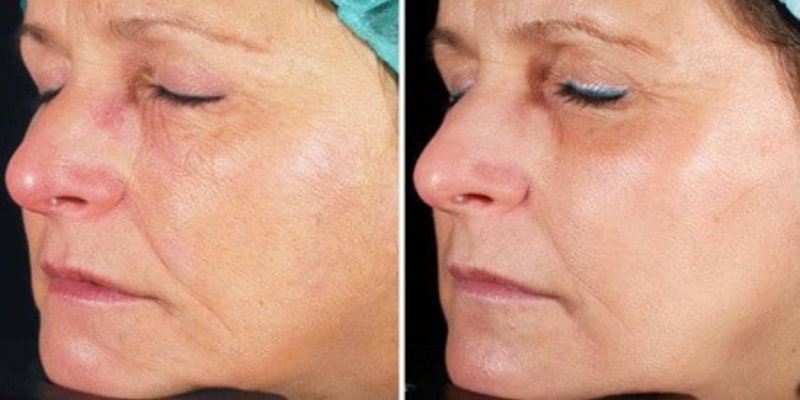 Laser Wrinkle Treatment