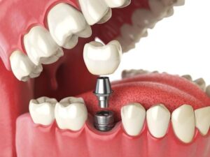 Fixed vs. Removable Tooth