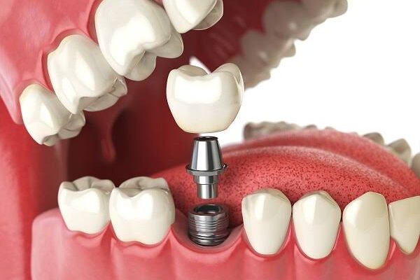 Fixed vs. Removable Tooth